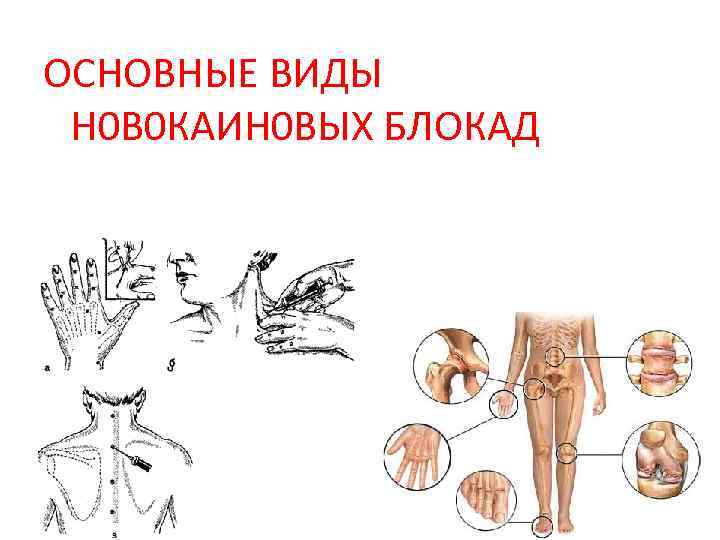 Новокаиновая блокада. Виды новокаиновых блокад. Новокаиновые блокады основные. Новокаиновые блокады в хирургии. Новокаиновая блокада техника.