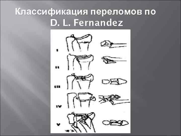 Классификация переломов по D. L. Fernandez 