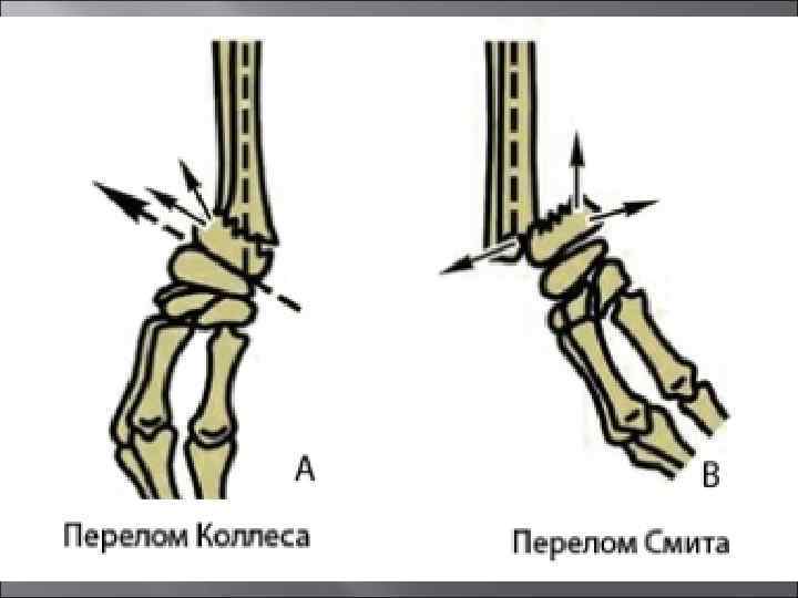 Повреждение кисти травматология презентация