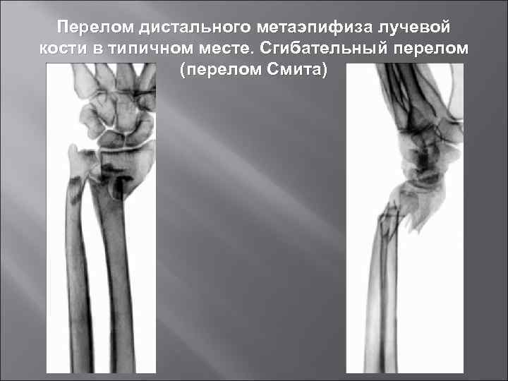 Перелом нижнего конца лучевой кости фото