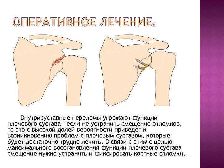 Внутрисуставные переломы угрожают функции плечевого сустава – если не устранить смещение отломков, то это