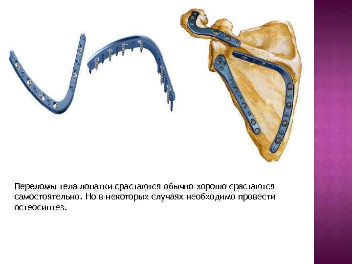 Переломы тела лопатки срастаются обычно хорошо срастаются самостоятельно. Но в некоторых случаях необходимо провести