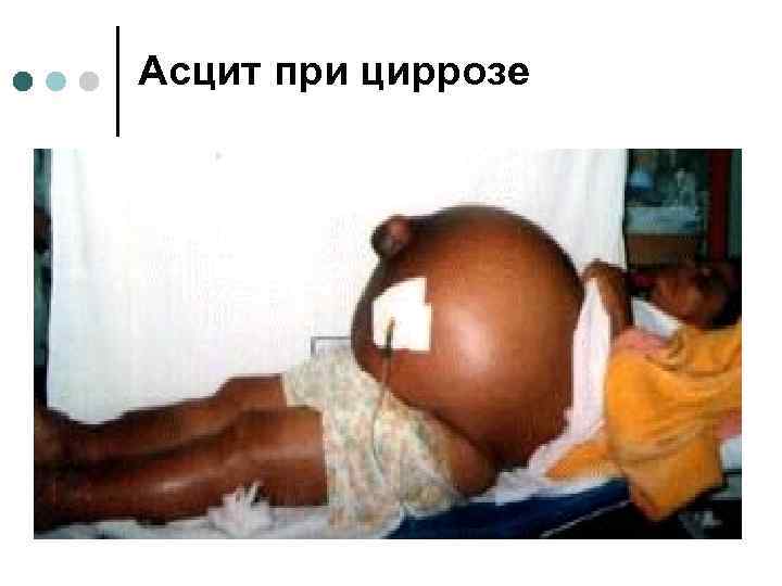 Асцит при циррозе 