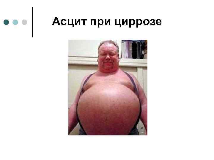 Асцит при циррозе 