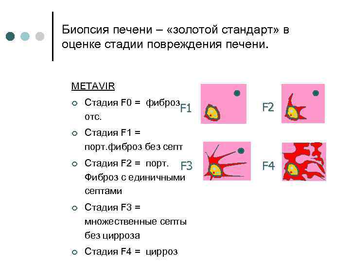 Биопсия печени – «золотой стандарт» в оценке стадии повреждения печени. METAVIR ¢ Стадия F