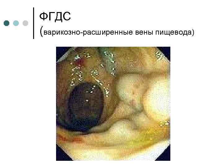 ФГДС (варикозно расширенные вены пищевода) 