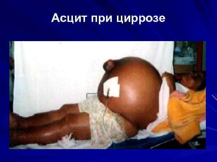Асцит при циррозе 