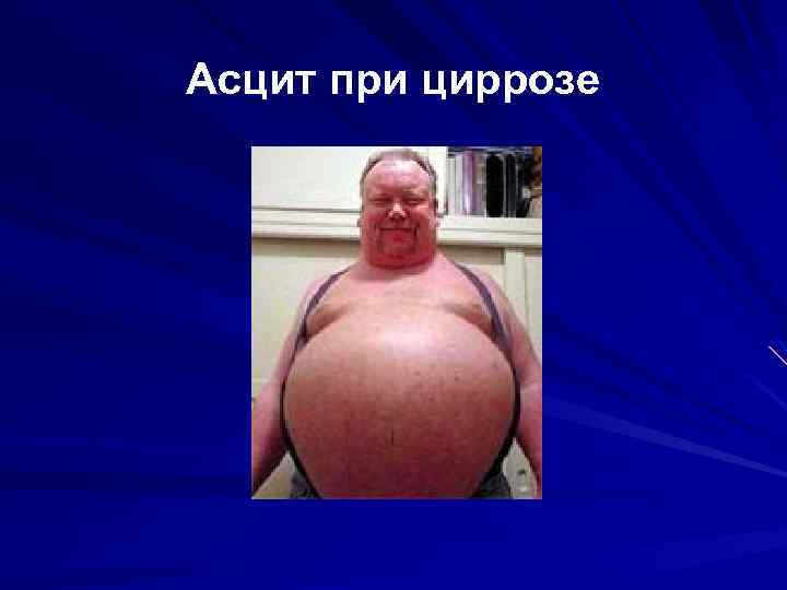 Асцит при циррозе 