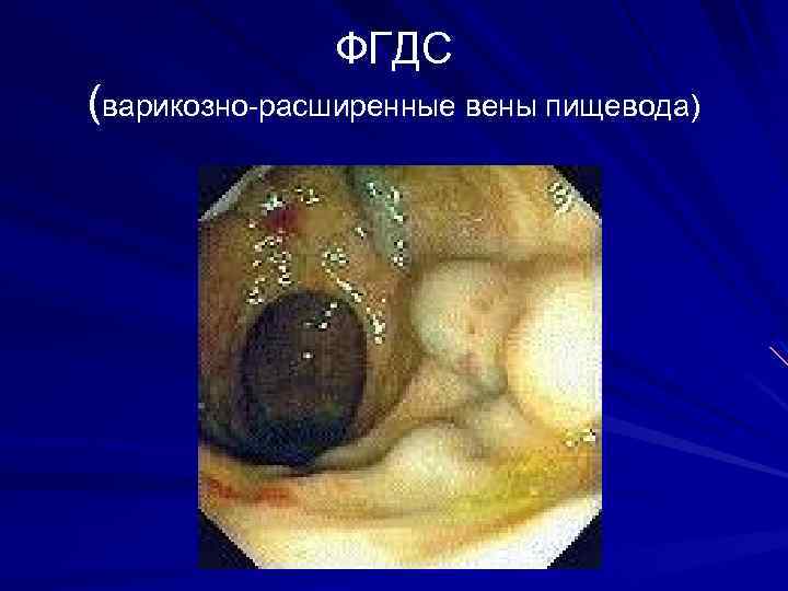 ФГДС (варикозно-расширенные вены пищевода) 