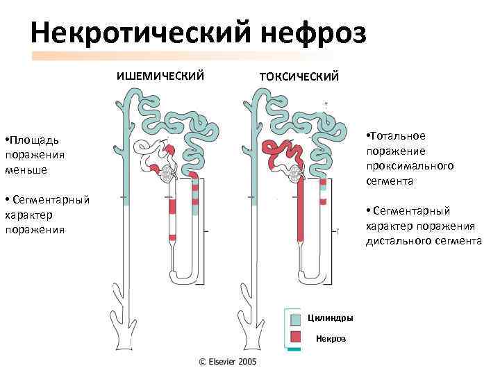 Некротический нефроз ИШЕМИЧЕСКИЙ ТОКСИЧЕСКИЙ • Тотальное поражение проксимального сегмента • Площадь поражения меньше •