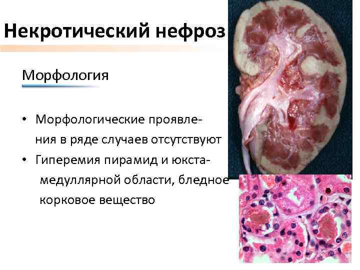 Некротический нефроз Морфология • Морфологические проявления в ряде случаев отсутствуют • Гиперемия пирамид и