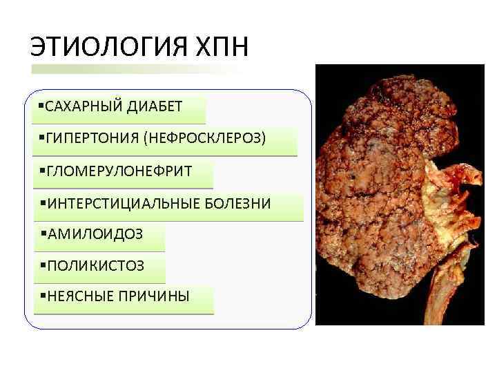 ЭТИОЛОГИЯ ХПН §САХАРНЫЙ ДИАБЕТ §ГИПЕРТОНИЯ (НЕФРОСКЛЕРОЗ) §ГЛОМЕРУЛОНЕФРИТ §ИНТЕРСТИЦИАЛЬНЫЕ БОЛЕЗНИ §АМИЛОИДОЗ §ПОЛИКИСТОЗ §НЕЯСНЫЕ ПРИЧИНЫ 