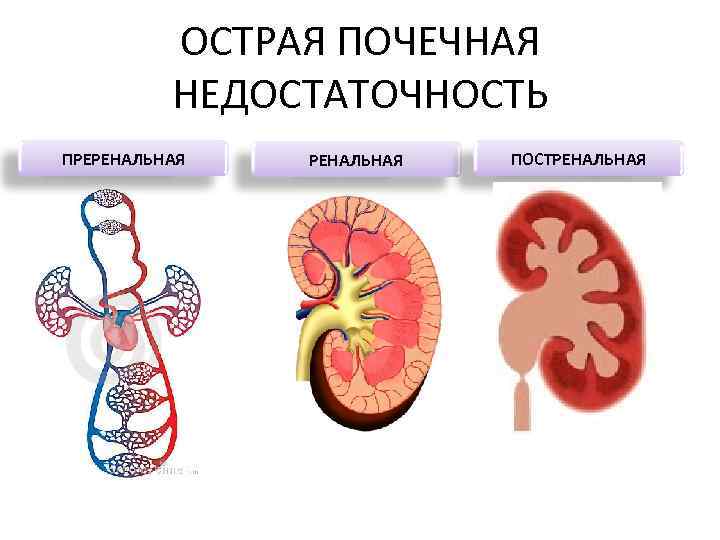 ОСТРАЯ ПОЧЕЧНАЯ НЕДОСТАТОЧНОСТЬ ПРЕРЕНАЛЬНАЯ ПОСТРЕНАЛЬНАЯ 