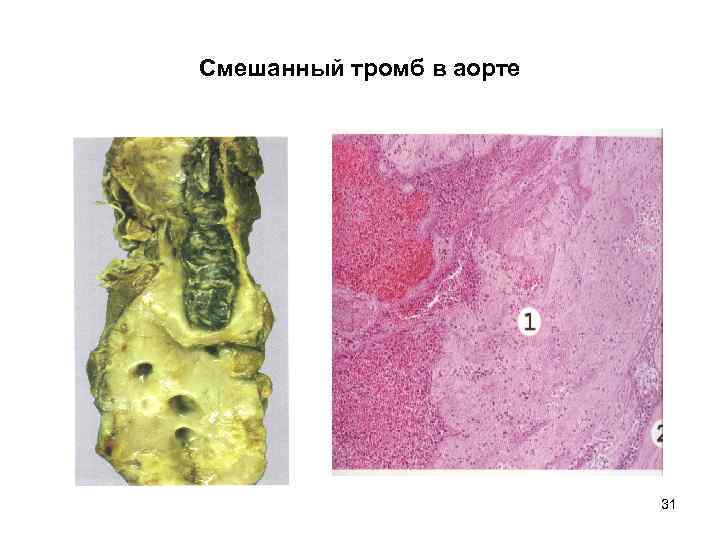 Смешанный тромб в аорте 31 