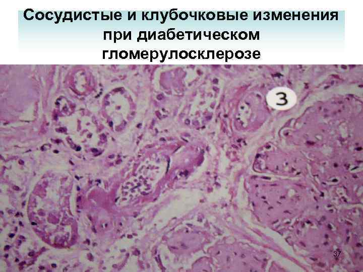 Сосудистые и клубочковые изменения при диабетическом гломерулосклерозе 37 