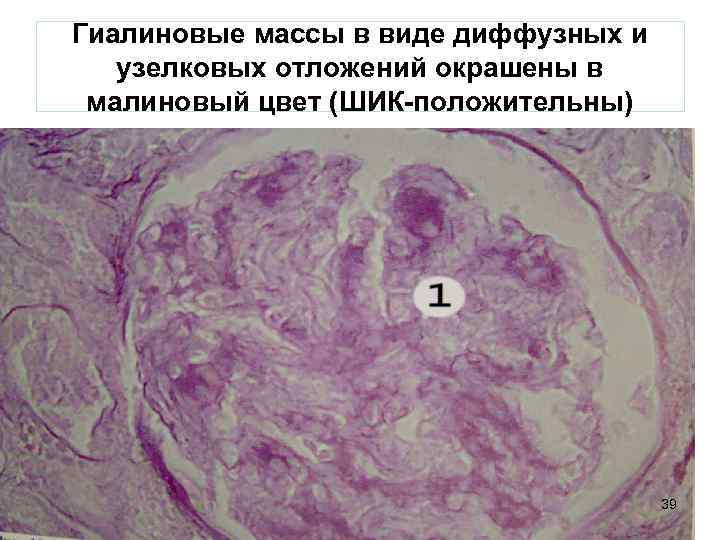 Гиалиновые массы в виде диффузных и узелковых отложений окрашены в малиновый цвет (ШИК-положительны) 39