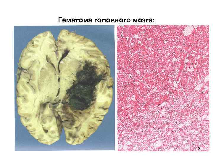 Гематома головного мозга: 42 
