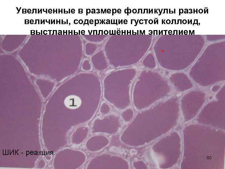 Увеличенные в размере фолликулы разной величины, содержащие густой коллоид, выстланные уплощённым эпителием ШИК -