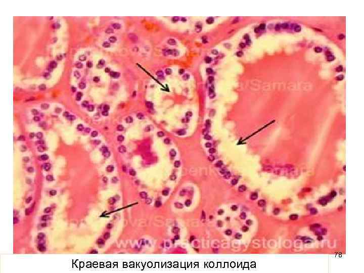 Краевая вакуолизация коллоида 78 