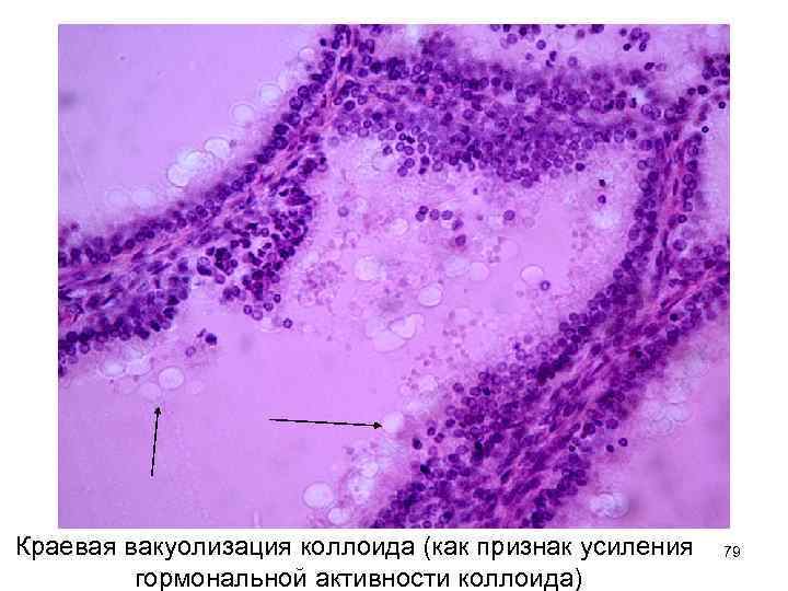 Краевая вакуолизация коллоида (как признак усиления гормональной активности коллоида) 79 