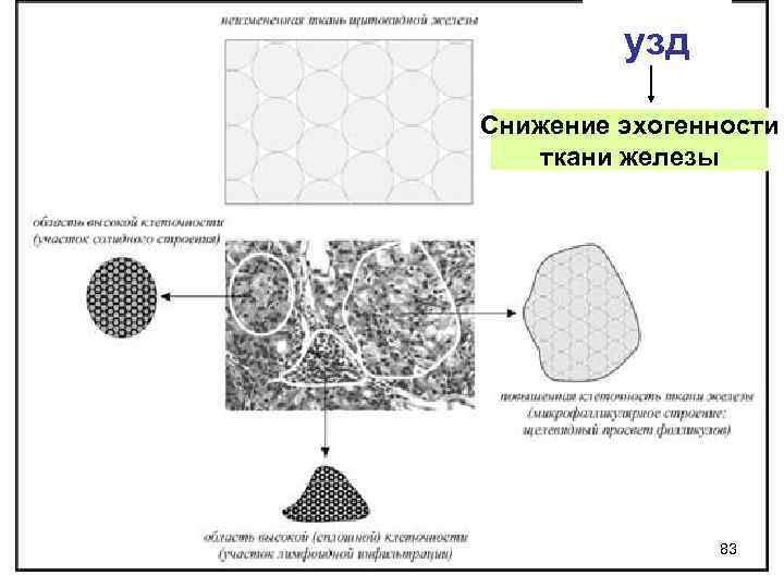 узд Снижение эхогенности ткани железы 83 