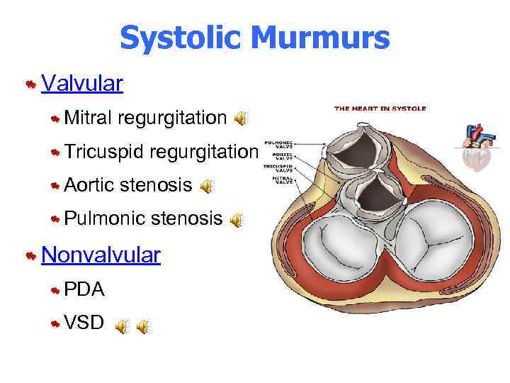 Systolic Murmurs Valvular Mitral regurgitation Tricuspid regurgitation Aortic stenosis Pulmonic stenosis Nonvalvular PDA VSD