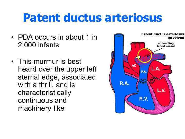 Patent ductus arteriosus • PDA occurs in about 1 in 2, 000 infants •