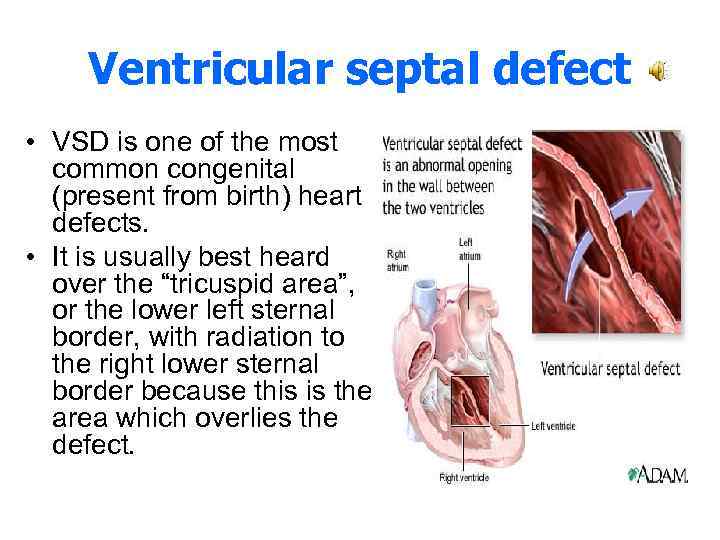 Ventricular septal defect • VSD is one of the most common congenital (present from