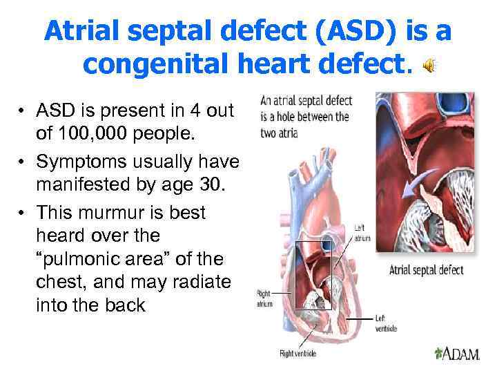 Atrial septal defect (ASD) is a congenital heart defect. • ASD is present in