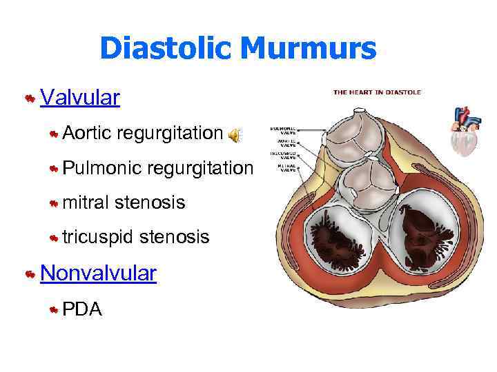 Diastolic Murmurs Valvular Aortic regurgitation Pulmonic regurgitation mitral stenosis tricuspid stenosis Nonvalvular PDA 