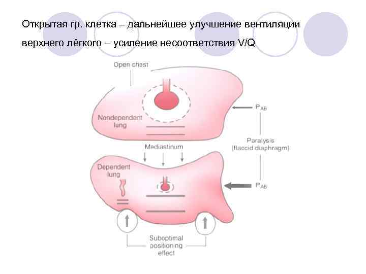 Открытая гр. клетка – дальнейшее улучшение вентиляции верхнего лёгкого – усиление несоответствия V/Q 