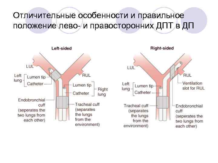Отличительные особенности и правильное положение лево и правосторонних ДПТ в ДП 