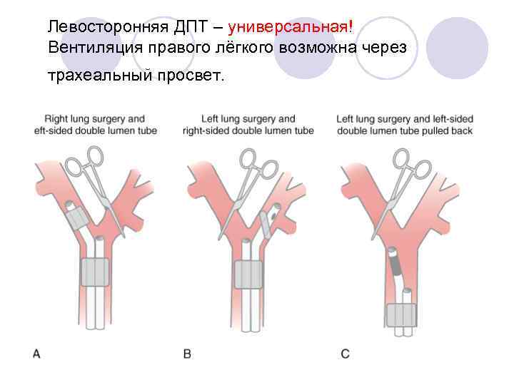 Левосторонняя ДПТ – универсальная! Вентиляция правого лёгкого возможна через трахеальный просвет. 