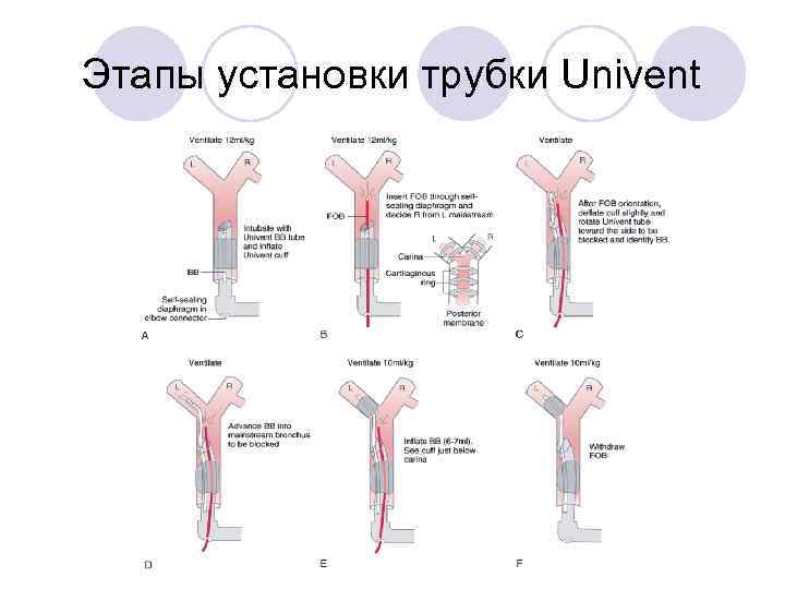 Этапы установки трубки Univent 