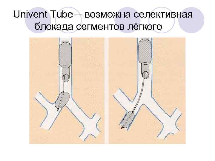 Univent Tube – возможна селективная блокада сегментов лёгкого 