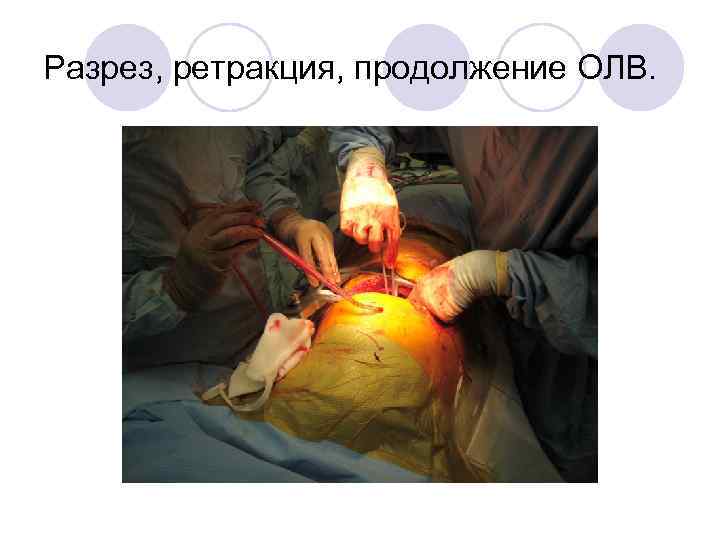 Разрез, ретракция, продолжение ОЛВ. 