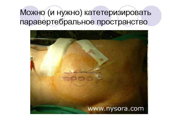 Можно (и нужно) катетеризировать паравертебральное пространство 