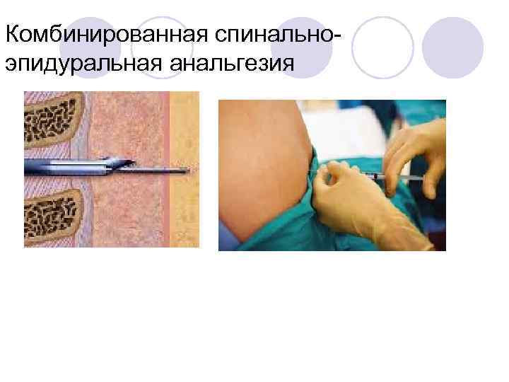 Комбинированная спинально эпидуральная анальгезия 