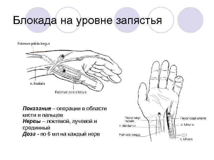 Блокада на уровне запястья Показания – операции в области кисти и пальцев Нервы –