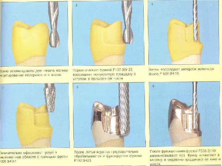 Препарирование под металлокерамическую коронку с уступом в картинках