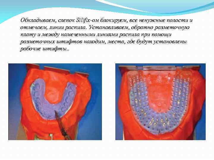 Обкладываем, слепок Silifix-ом блокируем, все ненужные полости и отмечаем, линии распила. Устанавливаем, обратно разметочную