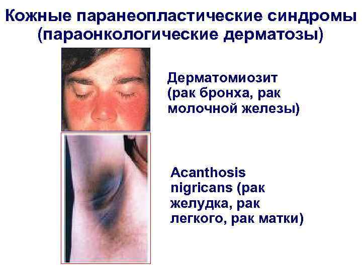 Кожные паранеопластические синдромы (параонкологические дерматозы) Дерматомиозит (рак бронха, рак молочной железы) Acanthosis nigricans (рак