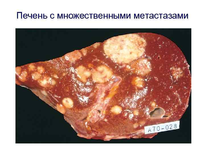 Печень с множественными метастазами 