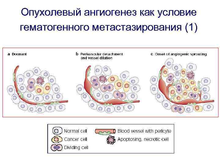Опухолевый ангиогенез как условие гематогенного метастазирования (1) 