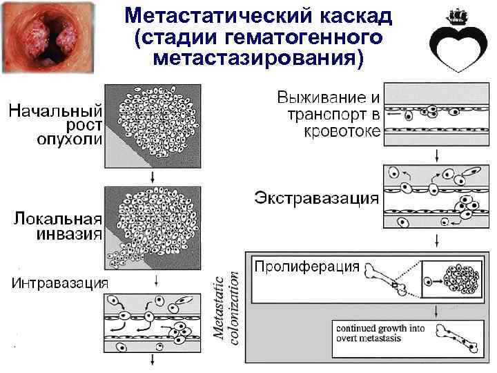 Метастатический каскад (стадии гематогенного метастазирования) 