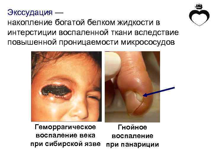 Экссудация — накопление богатой белком жидкости в интерстиции воспаленной ткани вследствие повышенной проницаемости микрососудов