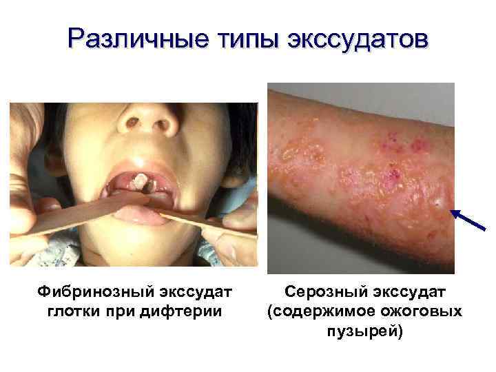 Различные типы экссудатов Фибринозный экссудат глотки при дифтерии Серозный экссудат (содержимое ожоговых пузырей) 