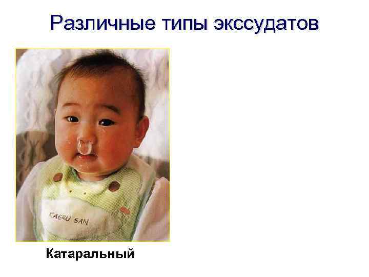 Различные типы экссудатов Катаральный 
