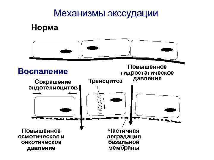 Механизмы экссудации Норма Воспаление Сокращение эндотелиоцитов Повышенное осмотическое и онкотическое давление Повышенное гидростатическое давление