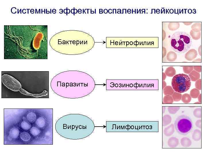Системные эффекты воспаления: лейкоцитоз Бактерии Нейтрофилия Паразиты Эозинофилия Вирусы Лимфоцитоз 